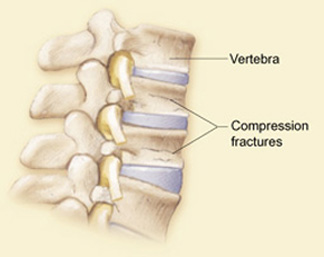 compression fracture spine