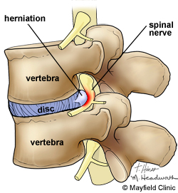 How Can You Prevent a Herniated Disc? - Virginia Spine Specialists