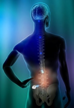 Neurostimulation Steps Virginia Spine Specialists
